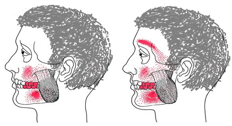 Masseter External Smerte Zone44