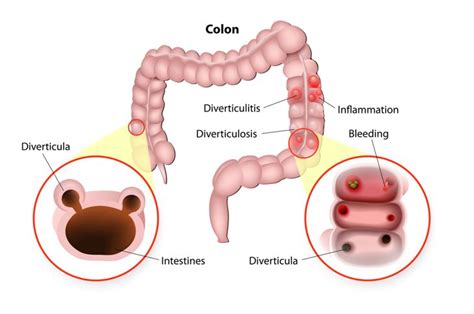 10 Causes of Hematochezia - Health & Detox & Vitamins