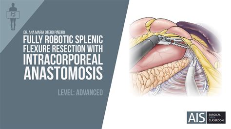 Ais Channel Fully Robotic Splenic Flexure Resection With