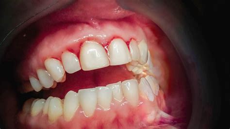 Gingivitis Causes Symptoms And Treatment