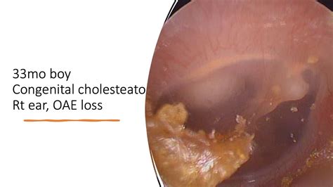 Lasic For Congenital Cholesteatoma Youtube