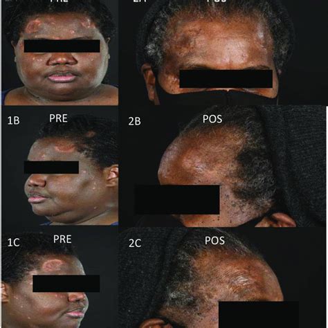 Pre Treatment Images Of A Patient With Cutaneous Sarcoidosis Presenting