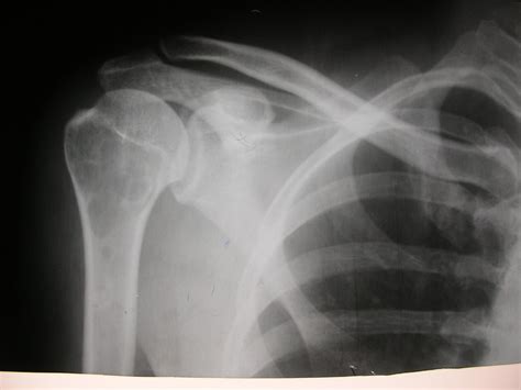 X-rays and Slides: Simple bone cyst in the proximal humerus