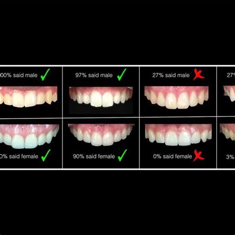 Pdf Prevalence Of Tooth Forms And Their Gender Correlation