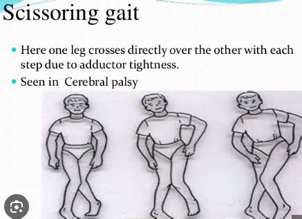 Ch Chronic Neuromuscular Disorders Flashcards Quizlet