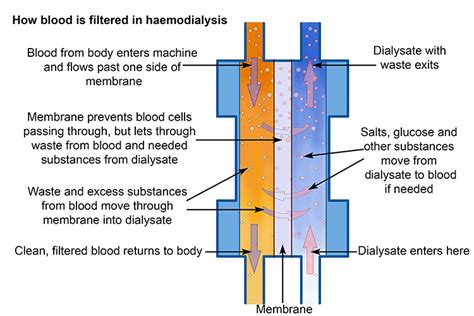 Details Showing How Haemodialysis Filters Waste From Blood