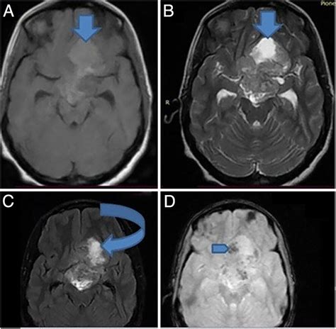 A Sellar Suprasellar Malignant Optic Pathway Glioblastoma In The