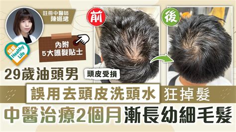 脫髮問題︳29歲油頭男誤用去頭皮洗頭水狂掉髮 中醫治療2個月漸長幼細毛髮 晴報 健康 生活健康 D220802