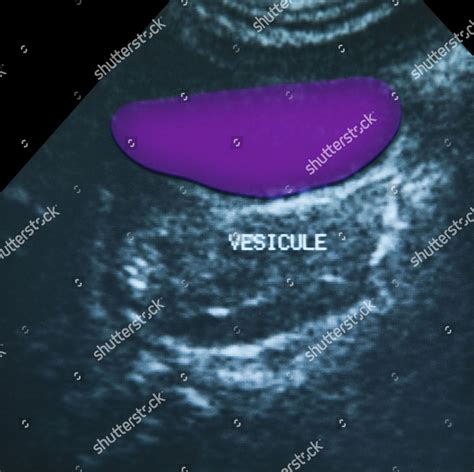 Gallbladder Ultrasound Scan Editorial Stock Photo Stock Image