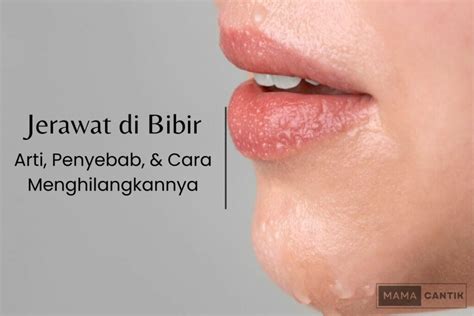 Jerawat Di Bibir Arti Penyebab Dan Cara Menghilangkan