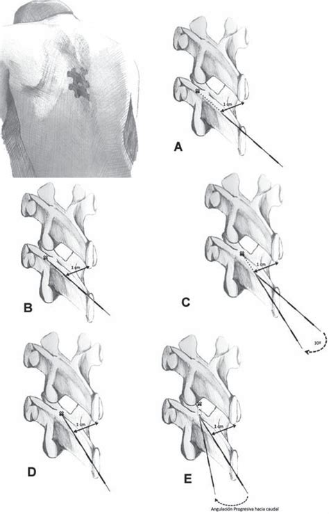 Analgesia Peridural Tor Cica Para Cirug A Tor Cica Y Abdominal Mayor