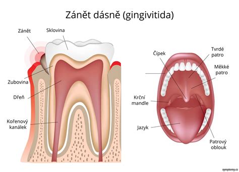 Zánět dásně příznaky a léčba