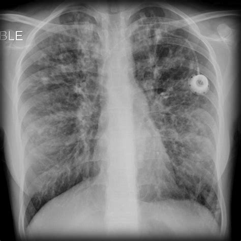 Cystic fibrosis chest x ray - wikidoc