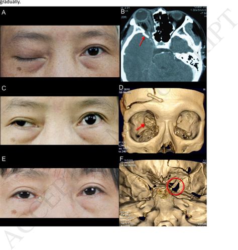 Clinical Management Of Traumatic Superior Orbital Fissure And Orbital