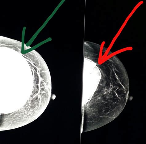 Mammogram Of The Same Breast 1 Year Apart Normal Implant Green