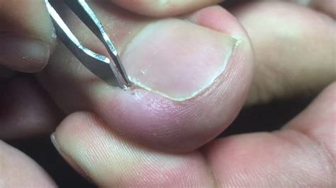 Stages Of Ingrown Toenail