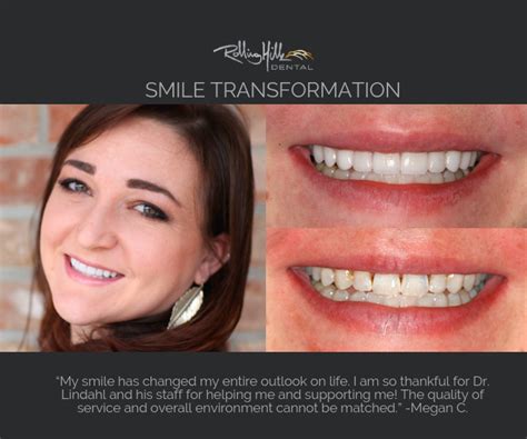 The Secret Behind Hollywoods Brightest Smiles Dental Veneers