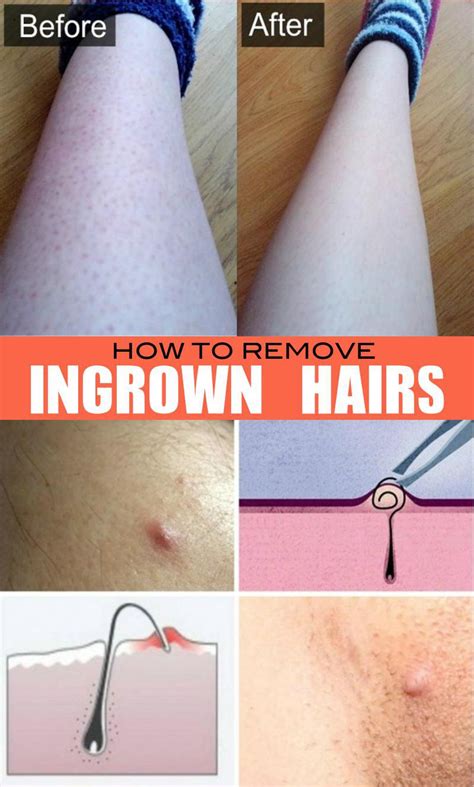 Best Thing To Do For Ingrown Hair How To Get Rid Of Ingrown Hairs