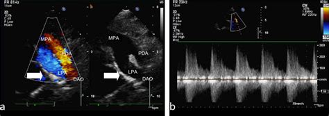 Typical Echocardiography Of Right Pulmonary Artery Absence A Short