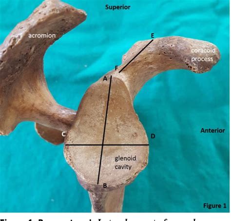 Figure 1 From Morphometric Analysis Of Coracoid Process And Glenoid Cavity In Terms Of Surgical