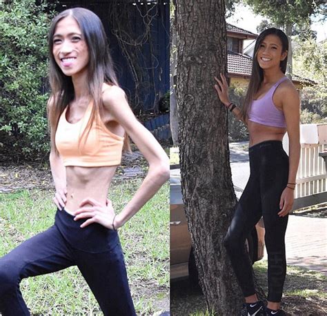 Medical student suffering anorexia nervosa exercises 3 hours daily ...