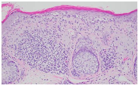 Atezolizumab Programmed Cell Death Ligand 1 Antibody Induced Inflammation Of Actinic Keratosis