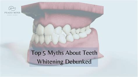 Top 5 Myths About Teeth Whitening Debunked