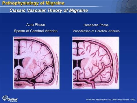 Pathophysiology Of Migraine