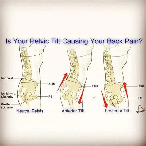 Pin By Nicola Amato On Pelvic Tilt Pelvic Tilt Back Pain Anatomy