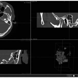 Three-dimensional reconstruction of computed tomography scans was ... 