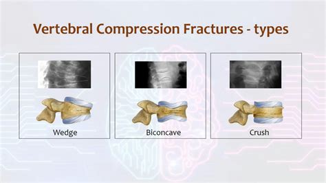 Solution Vertebral Compression Fractures Exploring Vertebral