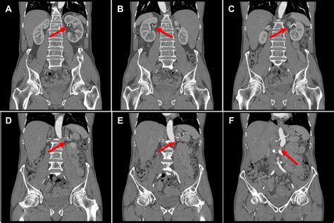 Incidental Finding Of Circumaortic Left Renal Vein Aneurysm On Imaging