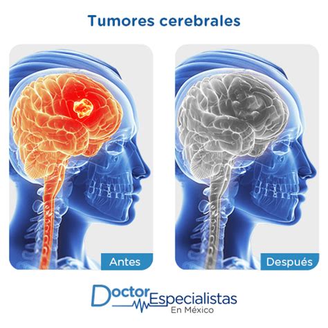 Especialistas En Cirugia De Tumores Cerebrales Doctor Especialistas