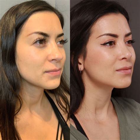 Rhinoplasty Experts Salt Lake City Ut Nose Jobs Utah Facial Plastics