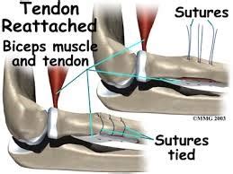 What is a Biceps Tendon Rupture and How is it Fixed?