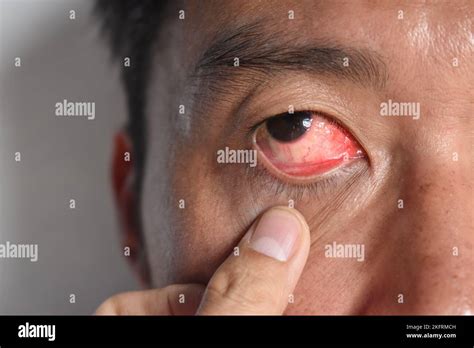 Corneal Infection Or Ulcer Called Keratitis In Asian Chinese Man Stock