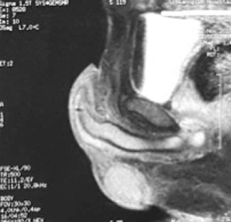 Follow Up Magnetic Resonance Imaging Scan At 3 Months Postoperatively