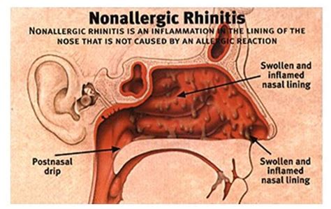 Allergic Rhinitis Signs And Symptoms