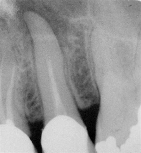 Periapical Radiographic Image Of Tooth 15 Devitalized With Apical