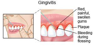 Gingivitis What You Need To Know