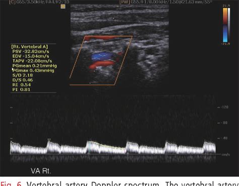 Figure 1 From General Principles Of Carotid Doppler Ultrasonography Semantic Scholar