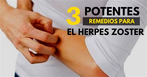 Como Curar El Herpes Naturalmente 3 Potentes Remedios Naturales Para