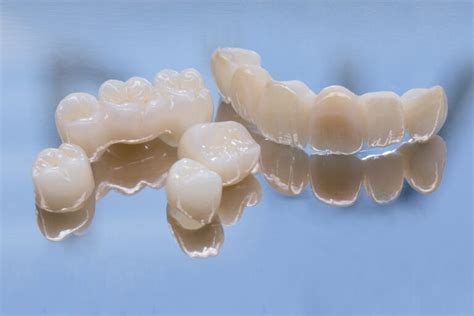 Dental PFMs A Guide To Porcelain Fused To Metal Crowns Smile Widely