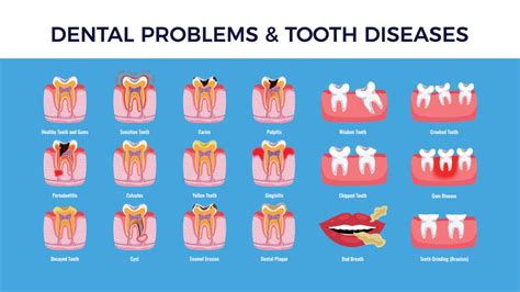 A Look Into Common Dental Problems And Diseases In 2020 Smile Angels