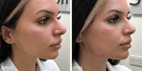 Jawline Fillers Before After Results At Skinly