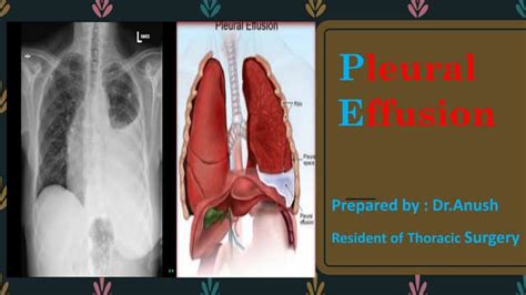 Pleural Effusion Dranush Ppt