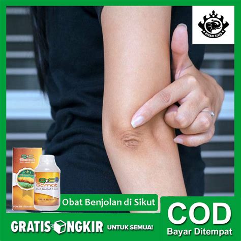 Jual Obat Herbal Benjolan Di Sikut Benjolan Di Siku Tangan Qnc Jelly