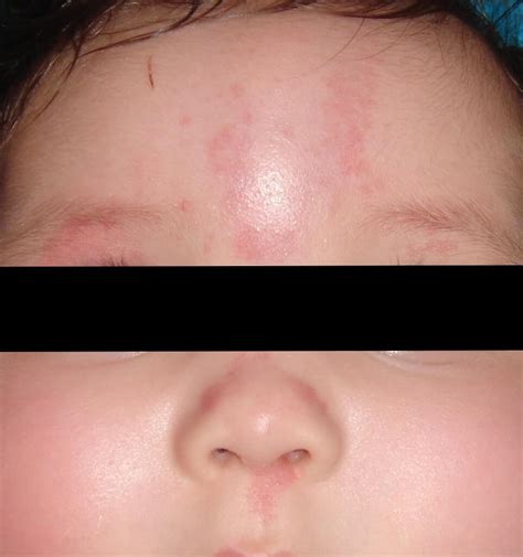 A Skin Lesion In Infants Nevus Flammeus Simplex