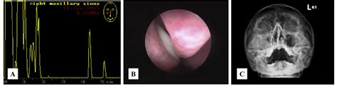 Figure 1 From Efficacy Of Sinus Ultrasound In Diagnosis Of Acute And