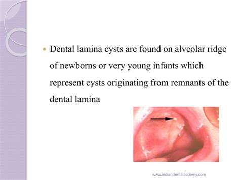 Gingival cyst of newborn /orthodontic courses by Indian dental academy